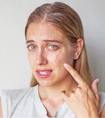 How To Get Rid Of Acne Scars And Pimple Marks Naturally how to get rid of acne scars and pimple