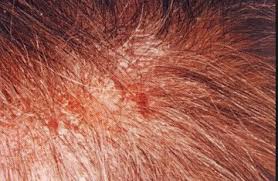 Red Itchy Sores On Scalp Psoriasis Remedies Scalp Psoriasis Sores On Scalp