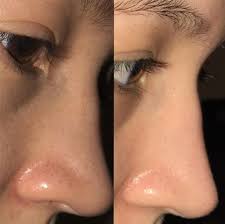Vitamin e oil and coconut oil are very good for treating eczema. This Woman On Reddit Got Rid Of Her Blackheads In 4 Weeks And I M Crying Skin Care Women Skin Care Get Rid Of Blackheads