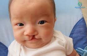 Hội chứng Edwards là gì? Có chữa khỏi được hay không?