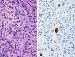 This condition occurs in the setting of patients with a weakened immune system who are susceptible. Cmv Esophagitis Sequelae Of Radiation Therapy Springerlink