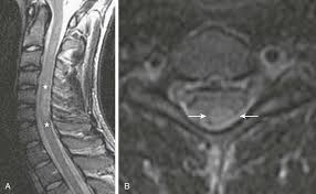 Image result for Spinal Infection