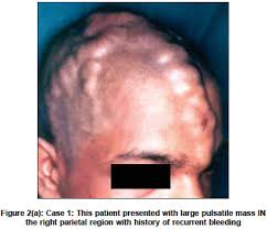 Image result for scalp aneurysm