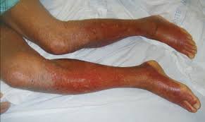 Image result for Stasis Dermatitis