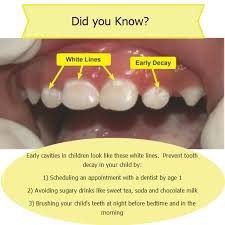Sep 21, 2020 · the treatment for front teeth cavities is the same as for any other cavity. Zany Tooth Decay Front Teeth Toothcare Toothdecayroots Dental Surgery Food Cavities In Kids Tooth Decay
