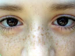 Image result for Freckled skin