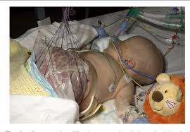 Various products offer a choice of. Figure 2 From Laparostomy Closure In Stage 4s Neuroblastoma Semantic Scholar