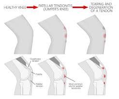 Patellar tendonitis also known by the name of jumper's knee or patellar tendinitis is a medical condition where an individual starts experiencing pain at the lower part of the patella or kneecap. Patellar Tendonitis Causes And Solutions Bioskin Innovative Bracing