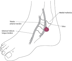 A medial malleolar fracture occurs in the inner bone of the ankle. Evaluation Of The Ankle Musculoskeletal And Connective Tissue Disorders Msd Manual Professional Edition