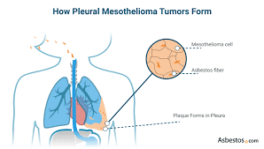 Pleural mesothelioma is a rare type of cancer that causes the abnormal and malignant cell growth of the pleural layer of the lungs. Pleural Mesothelioma Causes Symptoms Treatment And Top Doctors