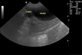 Copyright © by harpercollins publishers. Ultrasonido En Utero Y Ovarios