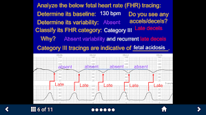 Image result for FHR Variability
