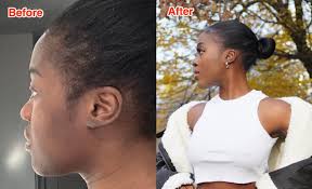 Why Some Black Women Are Using Botox to Achieve Smoothed Edges