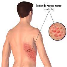 Es el mismo virus que causa la varicela. Mitos De La Culebrilla Tecnologo Acast