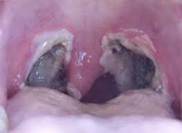 We did not find results for: Secondary Haemorrhage After Tonsillectomy Ent Mcq