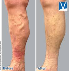 Because the venous procedure we do here at the advanced vein clinic is treating the medical cause of varicose veins, you will find varicose vein removal covered by insurance. How Much Varicose Vein Treatment Costs Without Insurance