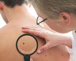 Your doctor will do tests to find out if it has moved, or metastasized. Melanoma Skin Cancer How A Skin Check Can Keep You Alive