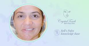 Aug 05, 2017 · bell's palsy exercises. Seven Steps Towards Recovery From Acute Bell S Palsy Crystal Touch Bell S Palsy Clinic