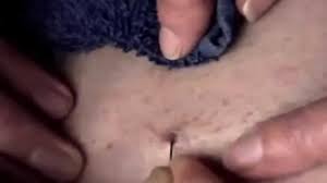 Go to my profile and you can find all about how to remove acne material there. Deep Blackhead Close Up Blackhead Removal Video Youtube