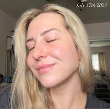 OKAYYY SKIN ✨ (this is gonna be a long one) Some of you know, most of you  don't but the past 7 months I've been dealing with the worst acne  experience since