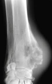 Right now, there are no conformal proton beam radiation therapy machines in canada. Bone Tumors In Dogs And Cats Musculoskeletal System Veterinary Manual