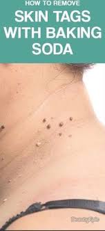 How To Remove Skin Tags With Baking Soda And Castor Oil In 2020 Skin Tag Removal Skin Tag Beauty Care