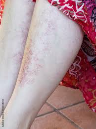 Image result for allergy rash on the legs