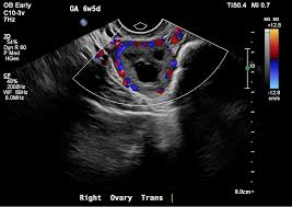 Image result for corpus luteum sonography)
