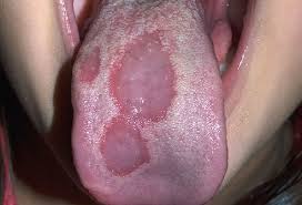17 Mouth Tongue Problems Pictures Of Sores Blisters Bumps And More