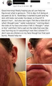 We did not find results for: This Nurse Is Posting Horrific Photos On Instagram From People Who Tried A Diy Chemical Peel In Quarantine