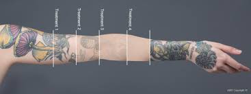 What if there was a way to remove it with as little pain as possible in as little time as possible? Laser Tattoo Removal Bournemouth Poole Ringwood Resolve Clinics
