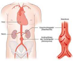 Aneurysma Der Bauchschlagader Bauchaortenaneurysma