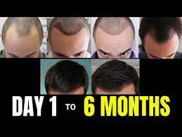 6 Months Evolution Hair Transplant Best Hair Transplant Hair Transplant Results