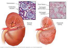 Chronic kidney disease, also called chronic kidney failure treatment for chronic kidney disease focuses on slowing the progression of the kidney damage, usually by controlling the underlying cause. End Stage Renal Disease Symptoms And Causes Mayo Clinic