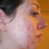 The best way to get rid of spot scarring will essentially vary depending on the nature of the scar for example deep scars such as ice pick scars may not be effectively treated using such options as laser and skin peels. 1