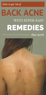 How To Get Rid Of Back Acne With Super Easy Remedies That Work Naturalacneremedies Back Acne Treatment Natural Acne Remedies Acne Remedies Fast