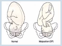 Image result for Manual Rotation in Occipitoposterior Presentation