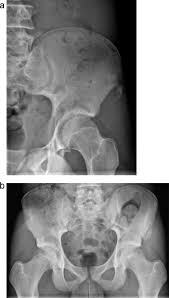 When cells grow too quickly or mutated cells crowd out normal cells, it can result in cancer. Bone And Soft Tissue Tumors Of Hip And Pelvis Sciencedirect