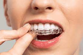 The number of support braces match your pour selection (5 pour = 5 support braces) • color dye is optional. The Pitfalls Of Diy Clear Aligners From Smiledirectclub And Candid Co