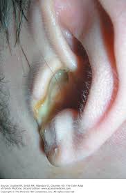 Image result for Acute Otitis Externa