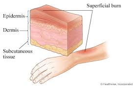 We did not find results for: First Degree Burn Superficial Burn Northshore