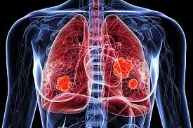 And what is the first sign of cancer? Advances In Lung Cancer