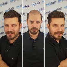 Neo Hair Farki Protezsac Toppik Protezsac Sacdokulmesi Sacekimi Sacdovmesi Sacdokulmesi Sacekimi Sacprotezi Peruk Sack Sac Dokulmesi Emo Sac