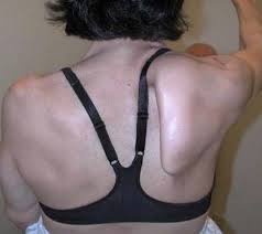 Image result for Winged Scapula