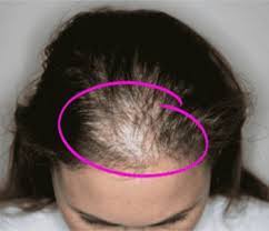 This is the female hair loss frontal hairline i.e. 570 Hair Regrowth Treatments Ideas Hair Regrowth Treatments Hair Regrowth Regrowth
