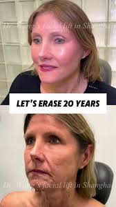 วิธีหน้าเด้งโดยไม่ต้องตัดผิว