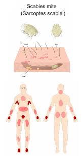 Image result for scabies in the groin area