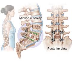 I Was On A Popular Spine Health Forum Talking With A Few People About Spinal Fusion And Reading Some Of The A Spinal Fusion Spine Surgery Spinal Fusion Surgery
