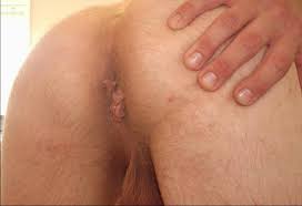 Bump on the anus: 7 causes and their treatments