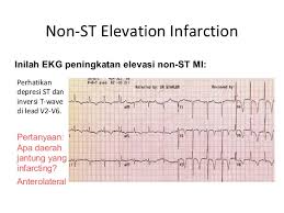 Yang harus disadari adalah bahwa ekg merupakan suatu test laboratorium, bukan merupakan 15. Interpretasi 12 Lead